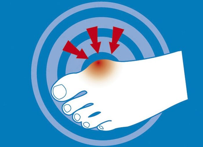 epitact Epithelium 26&reg; Hallux valgusbescherming 