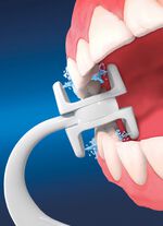 Extra opzetstukken voor Corp Care Miracle Smile monddouche WIT